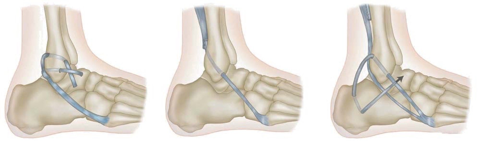 Ankle Ligamant Repair Reconsruction