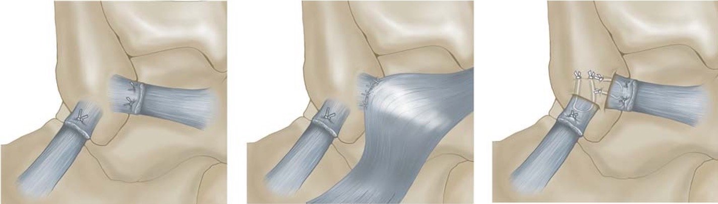 Ankle Ligamant Repair