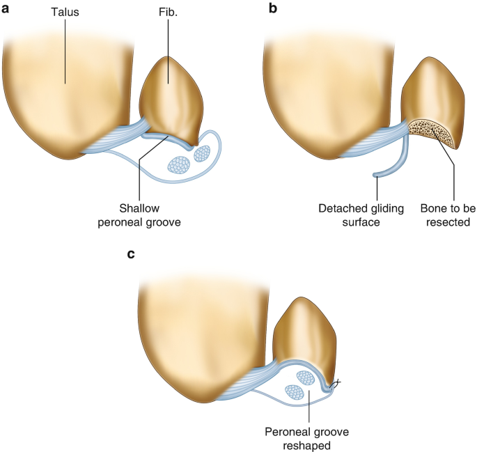 Ankle Peroneal Groove Deep