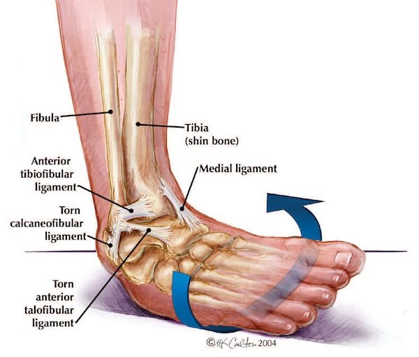 Ankle Sprain