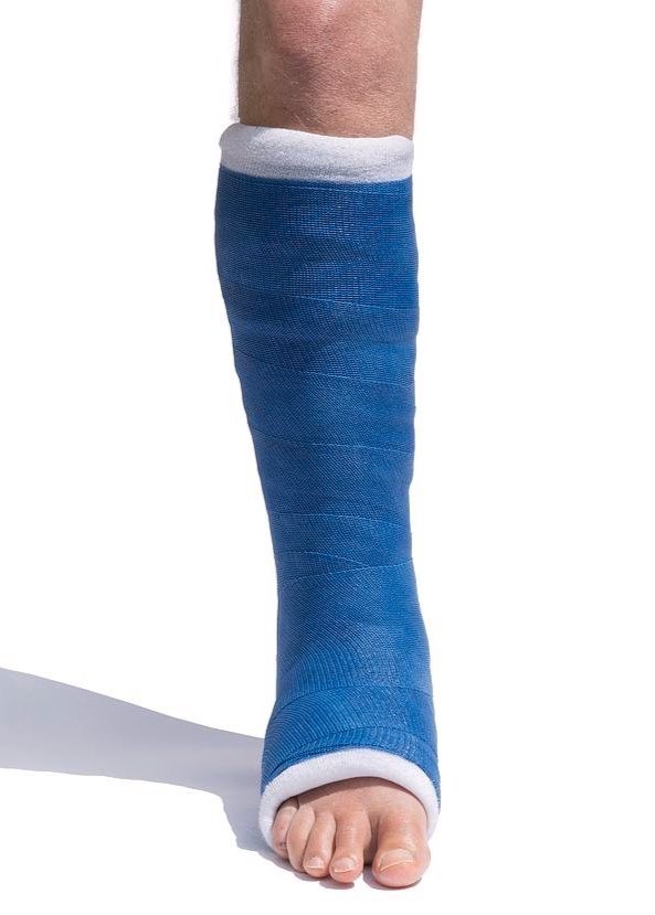 LEG CAST ANKLE LIGAMENT TREATMENT