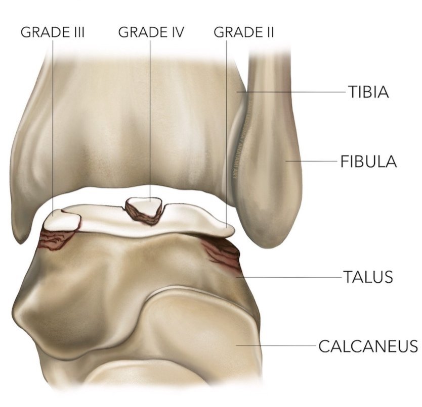 OCD Ankle Arthritis