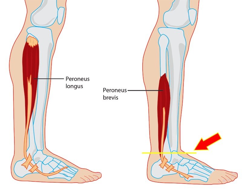 Peroneal Tendon Muscle Low Lying