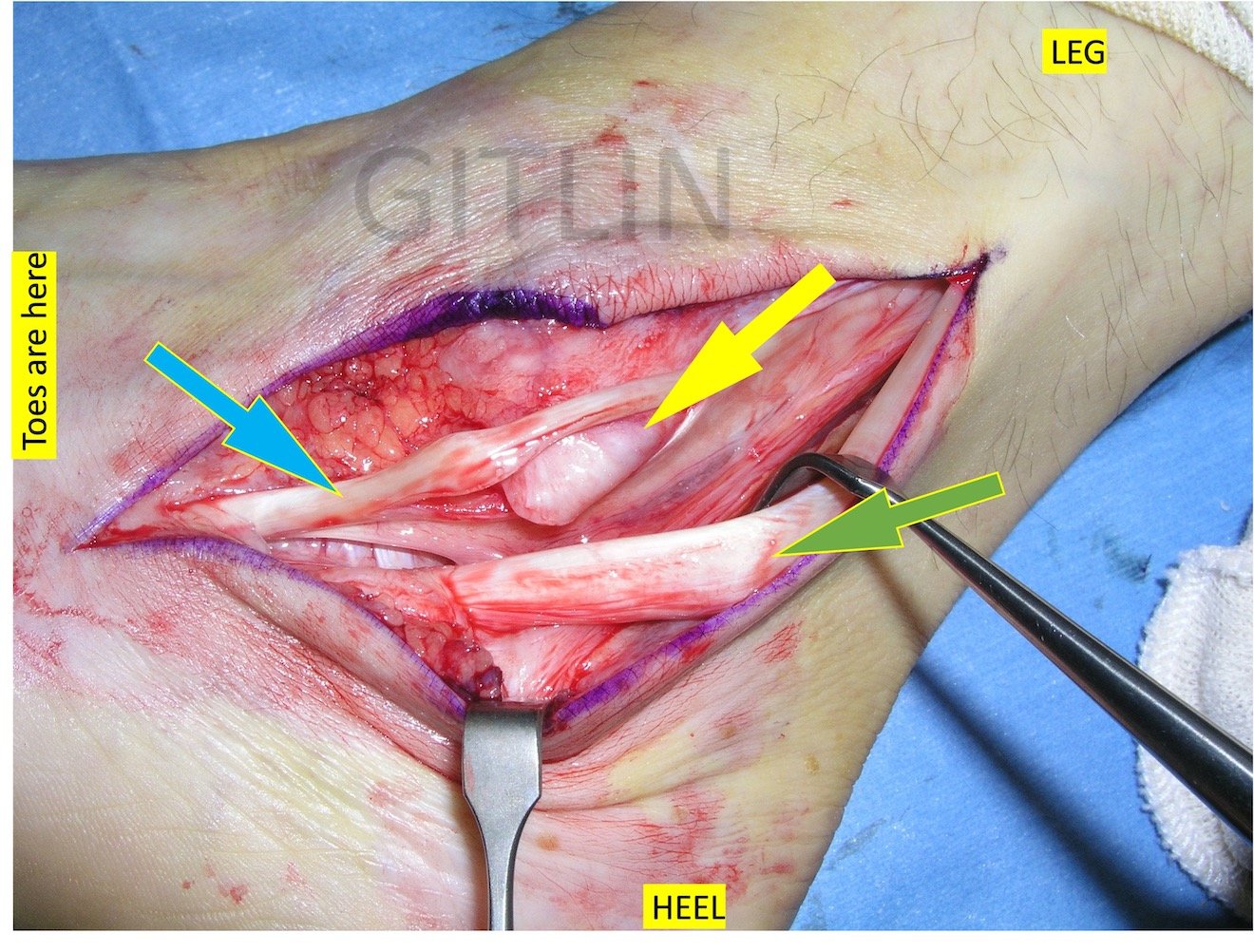 Peroneal Tendon Tear2